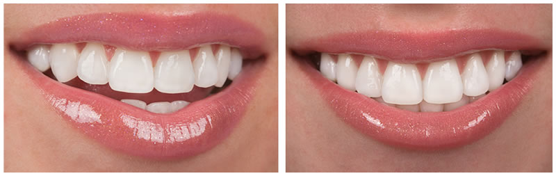 Beautiful Smiles Thanks To Cosmetic Dentistry