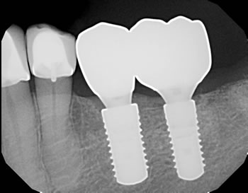 dental implant xray